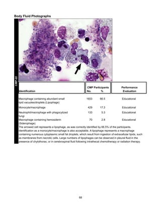 CMP-22

Body Fluid Photographs

CMP Participants
No.
%
1653

Macrophage containing abundant small
lipid vacuoles/droplets (Lipophage)
Monocyte/macrophage

66.5

Educational

429

Identification

Performance
Evaluation

17.3

Educational

Neutrophil/macrophage with phagocytized
133
5.3
Educational
fungi
Macrophage containing hemosiderin
70
2.8
Educational
(Siderophage)
The arrowed cell represents a lipophage, as was correctly identified by 66.5% of the participants.
Identification as a monocyte/macrophage is also acceptable. A lipophage represents a macrophage
containing numerous cytoplasmic small fat droplets, which result from ingestion of extracellular lipids, such
as membranes from necrotic cells. Large numbers of lipophages can be observed in pleural fluid in the
presence of chylothorax, or in cerebrospinal fluid following intrathecal chemotherapy or radiation therapy.

68

 