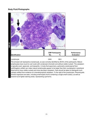 CMP-25

Body Fluid Photographs

Identification

CMP Participants
No.
%

Lymphocyte

2464

98.6

Performance
Evaluation
Good

The arrowed cell represents a lymphocyte, as was correctly identified by 98.6% of the participants. Mature
lymphocytes have round to oval nuclei with condensed chromatin and without visible nucleoli. The cytoplasm
is typically scant, agranular, and basophilic. In body fluid specimens, particularly cerebrospinal fluid,
centrifugation artifact can make mature lymphocytes appear to be larger than their counterparts in peripheral
blood and to have visible nucleoli and more abundant cytoplasm. Care should be taken to distinguish such
cytospin artifact from evidence of a hematolymphoid neoplasm. To the right of the lymphocyte, Pneumocystis
jirovecii organisms are seen, including small trophic forms containing a single small nucleus, as well as
several round lighter staining areas, representing cyst forms.

71

 