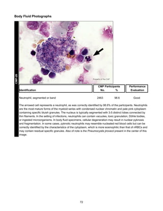 CMP-26

Body Fluid Photographs

CMP Participants
No.
%

Identification
Neutrophil, segmented or band

2463

98.6

Performance
Evaluation
Good

The arrowed cell represents a neutrophil, as was correctly identified by 98.6% of the participants. Neutrophils
are the most mature forms of the myeloid series with condensed nuclear chromatin and pale pink cytoplasm
containing specific bluish granules. The nucleus is typically segmented with 3-5 distinct lobes connected by
thin filaments. In the setting of infections, neutrophils can contain vacuoles, toxic granulation, Döhle bodies,
or ingested microorganisms. In body fluid specimens, cellular degeneration may result in nuclear pyknosis
and fragmentation. In some cases, pyknotic neutrophils may resemble nucleated red blood cells but can be
correctly identified by the characteristics of the cytoplasm, which is more eosinophilic than that of nRBCs and
may contain residual specific granules. Also of note is the Pneumocystis jirovecii present in the center of this
image.

72

 