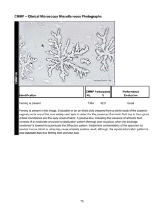 CMMP-36

CMMP – Clinical Microscopy Miscellaneous Photographs

CMMP Participants
No.
%

Identification
Ferning is present

1364

92.9

Performance
Evaluation
Good

Ferning is present in this image. Evaluation of an air-dried slide prepared from a sterile swab of the posterior
vaginal pool is one of the most widely used tests to detect for the presence of amniotic fluid due to the rupture
of fetal membranes and the early onset of labor. A positive test, indicating the presence of amniotic fluid,
consists of an elaborate arborized crystallization pattern (ferning) best visualized when the substage
condensor is lowered to accentuate the diffraction pattern. Inadvertent contamination of the specimen by
cervical mucus, blood or urine may cause a falsely positive result; although, the crystal arborization pattern is
less elaborate than true ferning from amniotic fluid.

75

 