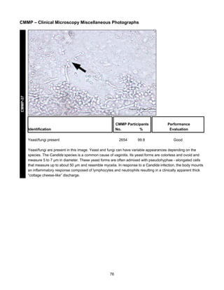 CMMP-37

CMMP – Clinical Microscopy Miscellaneous Photographs

CMMP Participants
No.
%

Identification
Yeast/fungi present

2654

99.8

Performance
Evaluation
Good

Yeast/fungi are present in this image. Yeast and fungi can have variable appearances depending on the
species. The Candida species is a common cause of vaginitis. Its yeast forms are colorless and ovoid and
measure 5 to 7 μm in diameter. These yeast forms are often admixed with pseudohyphae - elongated cells
that measure up to about 50 μm and resemble mycelia. In response to a Candida infection, the body mounts
an inflammatory response composed of lymphocytes and neutrophils resulting in a clinically apparent thick
“cottage cheese-like” discharge.

76

 