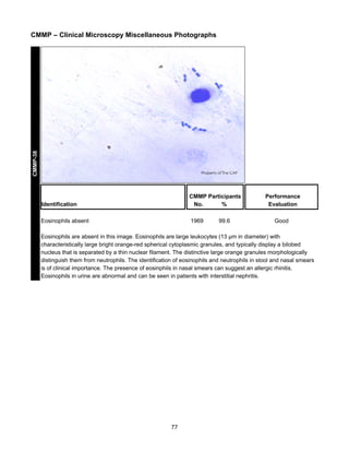 CMMP-38

CMMP – Clinical Microscopy Miscellaneous Photographs

Identification

CMMP Participants
No.
%

Eosinophils absent

1969

99.6

Performance
Evaluation
Good

Eosinophils are absent in this image. Eosinophils are large leukocytes (13 µm in diameter) with
characteristically large bright orange-red spherical cytoplasmic granules, and typically display a bilobed
nucleus that is separated by a thin nuclear filament. The distinctive large orange granules morphologically
distinguish them from neutrophils. The identification of eosinophils and neutrophils in stool and nasal smears
is of clinical importance. The presence of eosinphils in nasal smears can suggest an allergic rhinitis.
Eosinophils in urine are abnormal and can be seen in patients with interstitial nephritis.

77

 