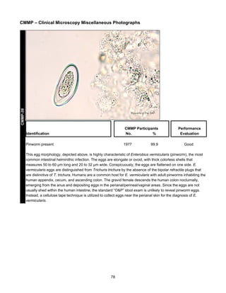 CMMP-39

CMMP – Clinical Microscopy Miscellaneous Photographs

CMMP Participants
No.
%

Identification
Pinworm present

1977

99.9

Performance
Evaluation
Good

This egg morphology, depicted above, is highly characteristic of Enterobius vermicularis (pinworm), the most
common intestinal helminithic infection. The eggs are elongate or ovoid, with thick colorless shells that
measures 50 to 60 μm long and 20 to 32 μm wide. Conspicuously, the eggs are flattened on one side. E.
vermicularis eggs are distinguished from Trichuris trichura by the absence of the bipolar refractile plugs that
are distinctive of T. trichura. Humans are a common host for E. vermicularis with adult pinworms inhabiting the
human appendix, cecum, and ascending colon. The gravid female descends the human colon nocturnally,
emerging from the anus and depositing eggs in the perianal/perineal/vaginal areas. Since the eggs are not
usually shed within the human intestine, the standard “O&P” stool exam is unlikely to reveal pinworm eggs.
Instead, a cellulose tape technique is utilized to collect eggs near the perianal skin for the diagnosis of E.
vermicularis.

78

 