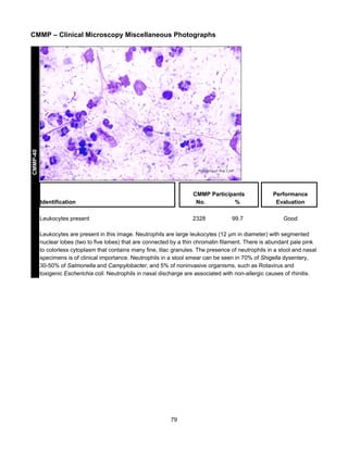 CMMP-40

CMMP – Clinical Microscopy Miscellaneous Photographs

Identification

CMMP Participants
No.
%

Leukocytes present

2328

99.7

Performance
Evaluation
Good

Leukocytes are present in this image. Neutrophils are large leukocytes (12 µm in diameter) with segmented
nuclear lobes (two to five lobes) that are connected by a thin chromatin filament. There is abundant pale pink
to colorless cytoplasm that contains many fine, lilac granules. The presence of neutrophils in a stool and nasal
specimens is of clinical importance. Neutrophils in a stool smear can be seen in 70% of Shigella dysentery,
30-50% of Salmonella and Campylobacter, and 5% of noninvasive organisms, such as Rotavirus and
toxigenic Escherichia coli. Neutrophils in nasal discharge are associated with non-allergic causes of rhinitis.

79

 