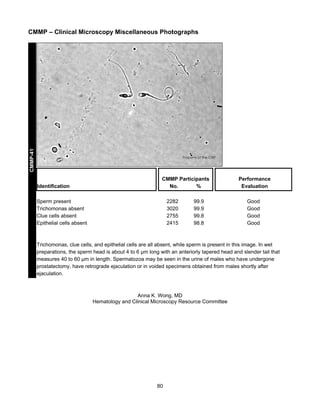 CMMP-41

CMMP – Clinical Microscopy Miscellaneous Photographs

Identification

CMMP Participants
No.
%

Sperm present
Trichomonas absent
Clue cells absent
Epithelial cells absent

2282
3020
2755
2415

99.9
99.9
99.8
98.8

Performance
Evaluation
Good
Good
Good
Good

Trichomonas, clue cells, and epithelial cells are all absent, while sperm is present in this image. In wet
preparations, the sperm head is about 4 to 6 μm long with an anteriorly tapered head and slender tail that
measures 40 to 60 μm in length. Spermatozoa may be seen in the urine of males who have undergone
prostatectomy, have retrograde ejaculation or in voided specimens obtained from males shortly after
ejaculation.

Anna K. Wong, MD
Hematology and Clinical Microscopy Resource Committee

80

 