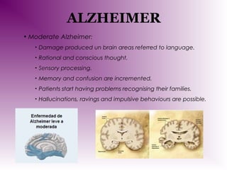 ALZHEIMER
• Moderate Alzheimer:
•

Damage produced un brain areas referred to language.

•

Rational and conscious thought.

•

Sensory processing.

•

Memory and confusion are incremented.

•

Patients start having problems recognising their families.

•

Hallucinations, ravings and impulsive behaviours are possible.

 