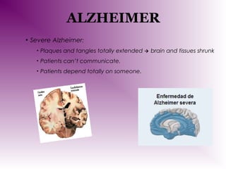 ALZHEIMER
• Severe Alzheimer:
•

Plaques and tangles totally extended

•

Patients can’t communicate.

•

Patients depend totally on someone.



brain and tissues shrunk

 