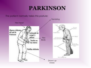 PARKINSON
The patient normally takes this posture:
Trembling
Flex head

Flex
Body

Drawn up
knees

 