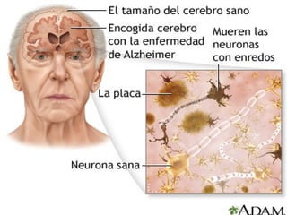 ALZHEIMER
Symptoms:
• Memory loss.

Shrunk brain

• Difficulties in language.
• Unpredictable behaviour.
• Plaques in the brain

­ Loss of connexion between neurons and brain.
­ Healthy neurons start working bad.

• Tangles in the brain

­ Finally they die.

It is extended to the hippocampus.
Essential for memories.

 