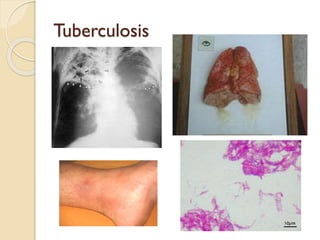 Tuberculosis

 