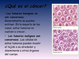 ¿Qué es el cáncer?     Los tumores benignos no son cancerosos.  Generalmente se pueden extraer .En la mayoría de los casos, estos tumores no vuelven a crecer..    Los tumores malignos son cancerosos.  Las células en estos tumores pueden invadir el tejido a su alrededor y diseminarse a otros órganos del cuerpo.  