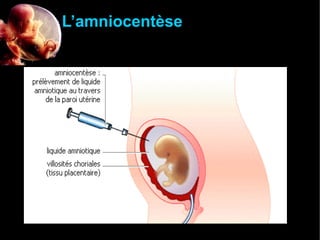 L’amniocentèse

 