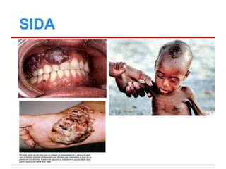 SIDA
 