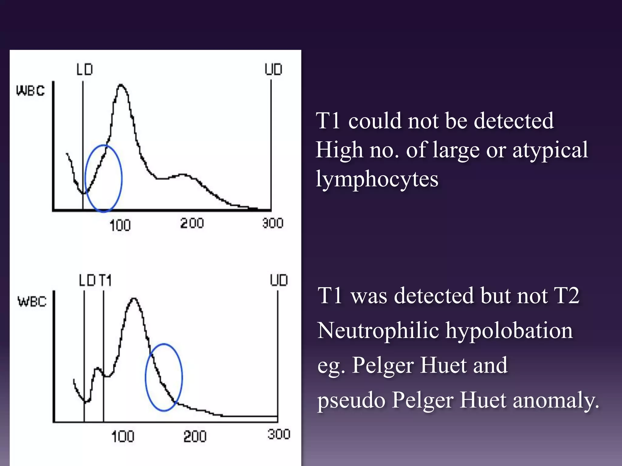 T1 could not be detected
High no. of large or atypical
lymphocytes
T1 was detected but not T2
Neutrophilic hypolobation
eg. Pelger Huet and
pseudo Pelger Huet anomaly.
 