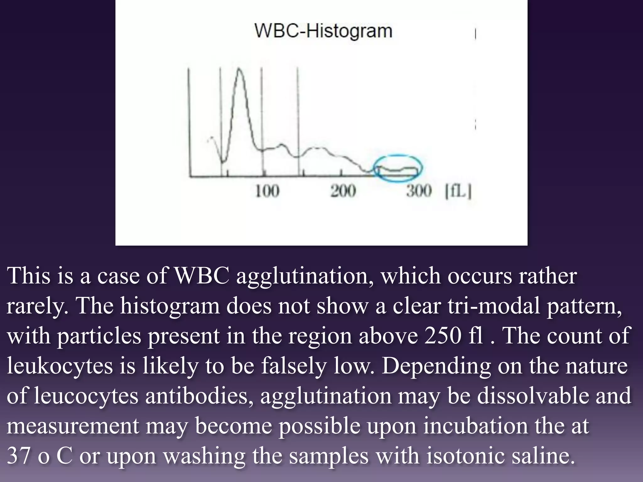 This is a case of WBC agglutination, which occurs rather
rarely. The histogram does not show a clear tri-modal pattern,
with particles present in the region above 250 fl . The count of
leukocytes is likely to be falsely low. Depending on the nature
of leucocytes antibodies, agglutination may be dissolvable and
measurement may become possible upon incubation the at
37 o C or upon washing the samples with isotonic saline.
 