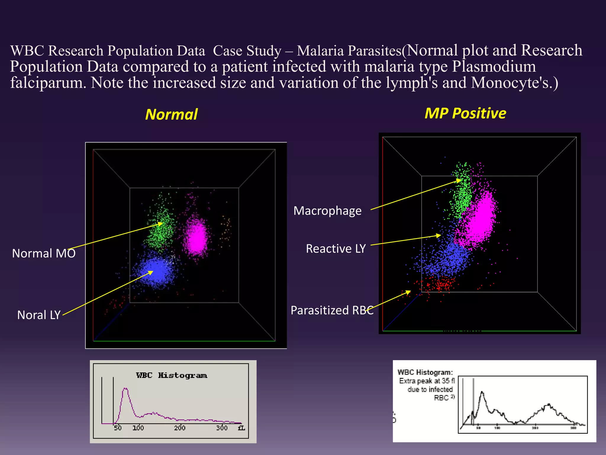 WBC Research Population Data Case Study – Malaria Parasites(Normal plot and Research
Population Data compared to a patient infected with malaria type Plasmodium
falciparum. Note the increased size and variation of the lymph's and Monocyte's.)
NORMAL
Normal
Normal MO
Noral LY
Macrophage
Parasitized RBC
MALARIA
MP Positive
Reactive LY
 