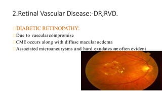 2.Retinal Vascular Disease:-DR,RVD.
DIABETIC RETINOPATHY:
Due to vascular compromise
CME occurs along with diffuse macular oedema
Associated microaneurysms and hard exudates are often evident
 