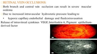 RETINAL VEIN OCCLUSIONS:
Both branch and central vein occlusion can result in severe macular
oedema
Due to increased intravascular hydrostatic pressure leading to
• hypoxic capillary endothelial damage and fluid extravasation
Release of intravitreal cytokines VEGF, Interleukin 6, Pigment epithelium-
derived factor
 