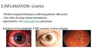 3.INFLAMATION:-Uveitis
Modern surgical techniques is allowing patients with uveitis,
who often develop cataract prematurely,
opportunities for intraocular lens placement.
Incidence of pseudophakic CME is greater in these patients
 