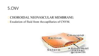 5.CNV
CHOROIDAL NEOVASCULAR MEMBRANE:
Exudation of fluid from the capillaries of CNVM.
 