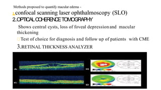 Methods proposed to quantify macular edema -
1.confocal scanning laser ophthalmoscopy (SLO)
2..OPTICALCOHERENCETOMOGRAPHY
Shows central cysts, loss of foveal depressionand macular
thickening
Test of choice for diagnosis and follow up of patients with CME
3.RETINAL THICKNESS ANALYZER
 
