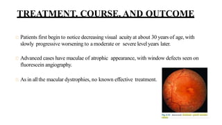TREATMENT, COURSE, AND OUTCOME
Patients first begin to notice decreasing visual acuity at about 30 years of age, with
slowly progressive worsening to a moderate or severe level years later.
Advanced cases have maculae of atrophic appearance, with window defects seen on
fluorescein angiography.
As in allthe macular dystrophies, no known effective treatment.
 
