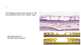 .
(A) Histology shows cystic spaces in the
outer plexiform and inner nuclear layer
(B) progression to
lamellar hole formation
 