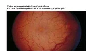 Cystoid macular edema in the Irvine-Gass syndrome.
The radial cystoid changes centered in the fovea causing a “yellow spot.”
 