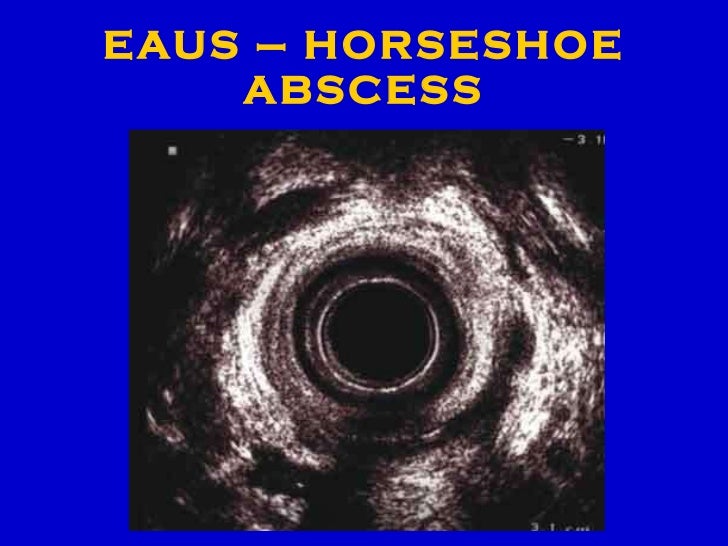 Evaluation of Complex Anal Fistula EUA, EUAS OR MRI?