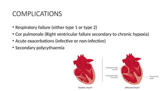 COMPLICATIONS
• Respiratory failure (either type 1 or type 2)
• Cor pulmonale (Right ventricular failure secondary to chronic hypoxia)
• Acute exacerbations (infective or non-infective)
• Secondary polycythaemia
 
