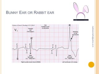 Cardiac Monitoring ECG PPTX cardiac-monitoring-ecg-pptx