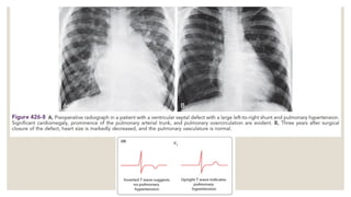 Comprehensive Overview of Common Congenital Heart Diseases in Children ...
