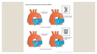 Comprehensive Overview of Common Congenital Heart Diseases in Children ...