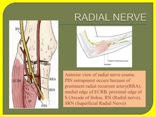 Anterior view of radial nerve course.
PIN entrapment occurs because of
prominent radial recurrent artery(RRA),
medial edge of ECRB, proximal edge of
S (Arcade of frohse, RN (Radial nerve),
SRN (Superficial Radial Nerve)
 