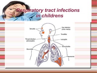 Title
Respiratory tract infections
in childrens
 