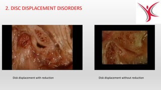 2. DISC DISPLACEMENT DISORDERS
Disk displacement with reduction Disk displacement without reduction
 