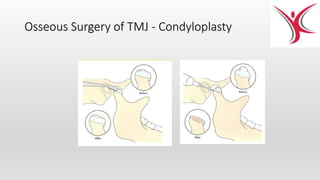 Osseous Surgery of TMJ - Condyloplasty
 