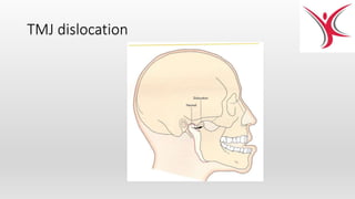 TMJ dislocation
 