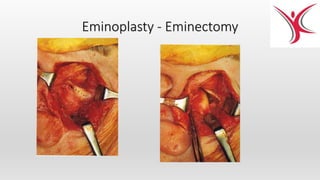Eminoplasty - Eminectomy
 
