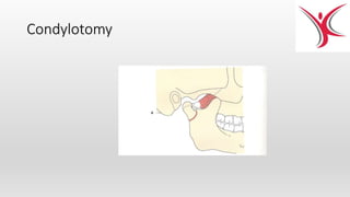 Condylotomy
 