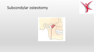 Subcondylar osteotomy
 