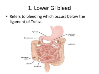 1. Lower GI bleed
• Refers to bleeding which occurs below the
ligament of Treitz.
 