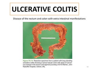 ULCERATIVE COLITIS
Disease of the rectum and colon with extra-intestinal manifestations
43
 