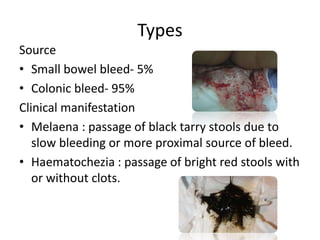 Types
Source
• Small bowel bleed- 5%
• Colonic bleed- 95%
Clinical manifestation
• Melaena : passage of black tarry stools due to
slow bleeding or more proximal source of bleed.
• Haematochezia : passage of bright red stools with
or without clots.
 