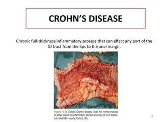 CROHN’S DISEASE
Chronic full-thickness inflammatory process that can affect any part of the
GI tract from the lips to the anal margin
54
 