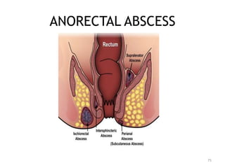 ANORECTAL ABSCESS
75
 
