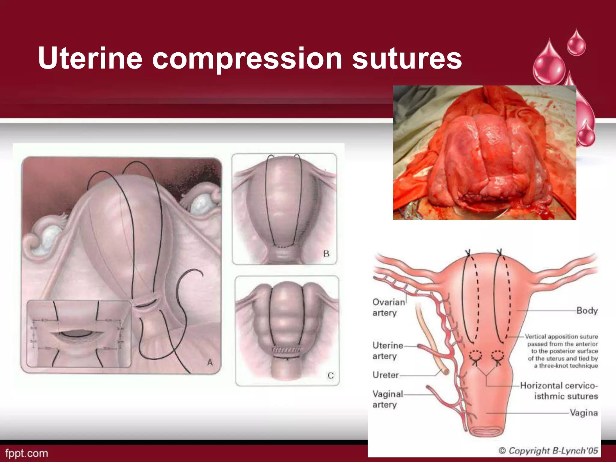 Uterine compression sutures
 