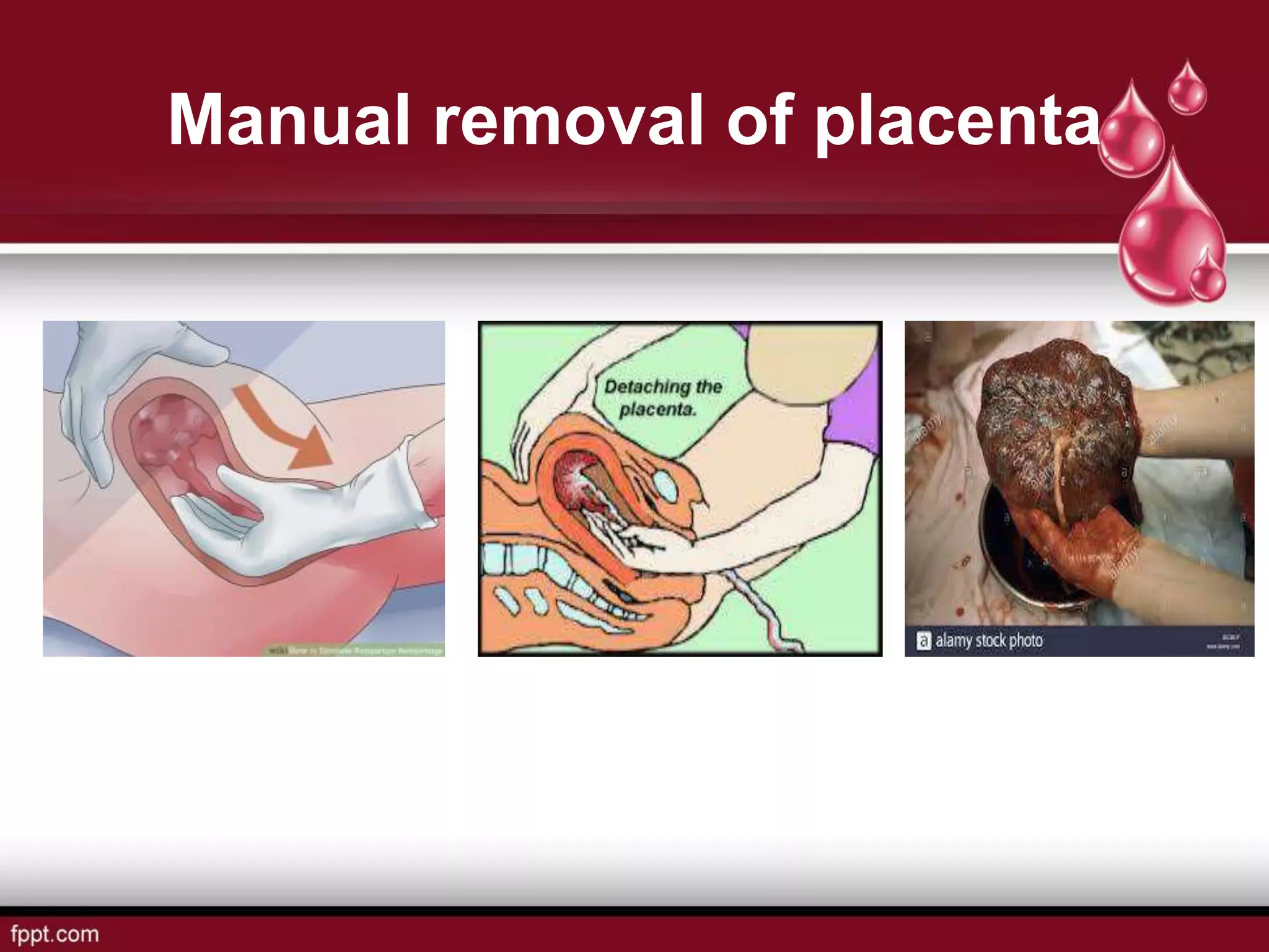 Manual removal of placenta
 