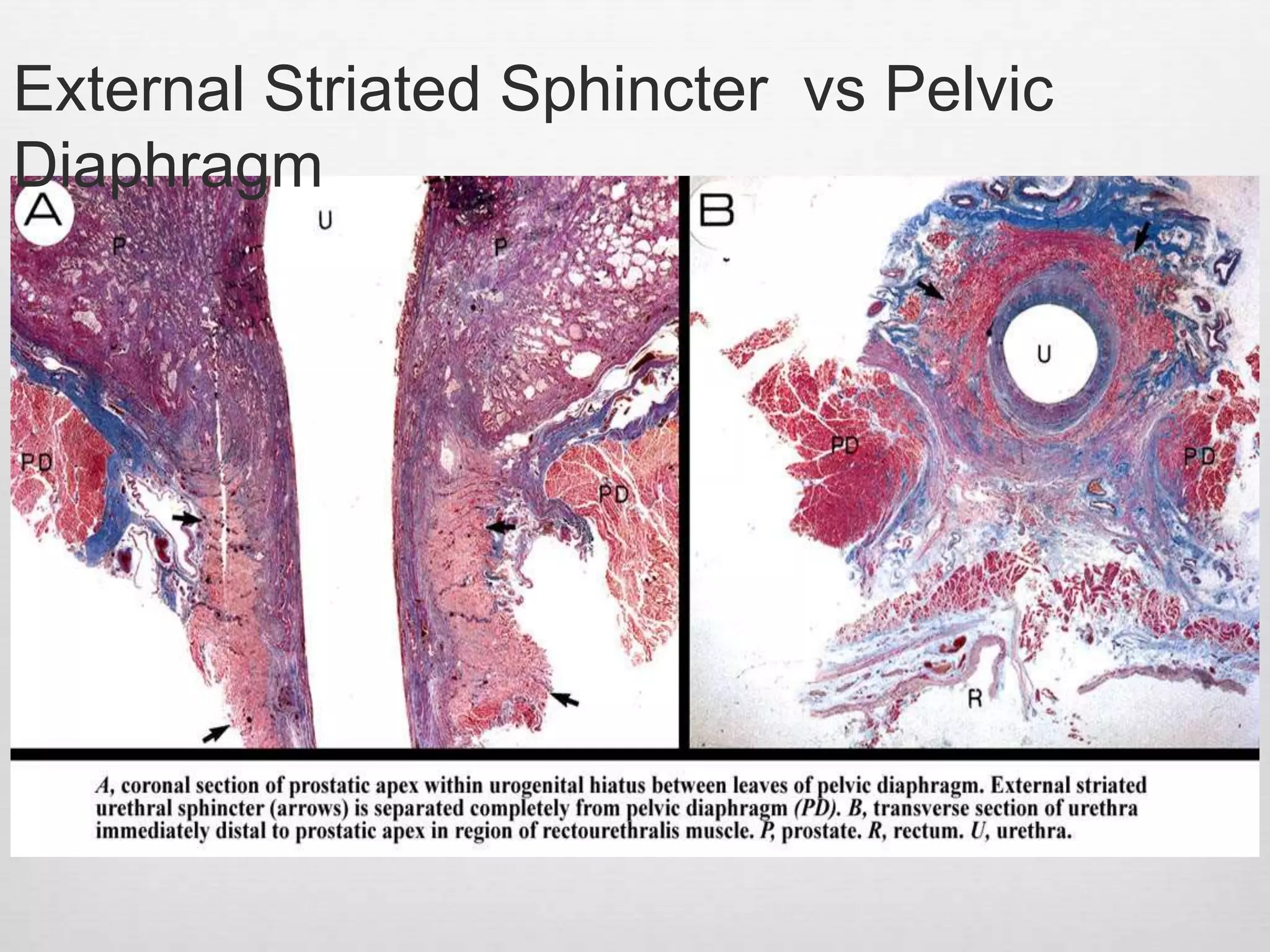 Prostate - Clinical Anatomy as applied to Prostate Cancer | PPTX