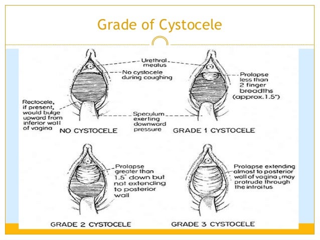 Prolapsed Bladder Stage 2 Pelvic Organ Prolapse ZUQHC Prolapsed Bladder Stage 2 Pelvic Organ Prolapse ZUQHC